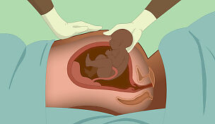 wow-l2-obstetric-fistula-id10095-04.jpg